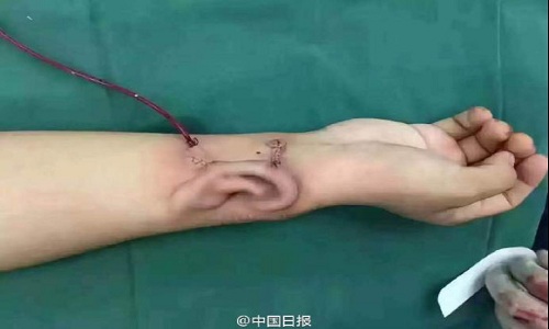 Bác sỹ Trung Quốc nuôi cấy tai trên tay bệnh nhân