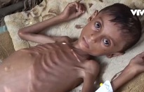Khoảng 20 triệu người thiếu ăn, Yemen đứng bên bờ vực của nạn đói