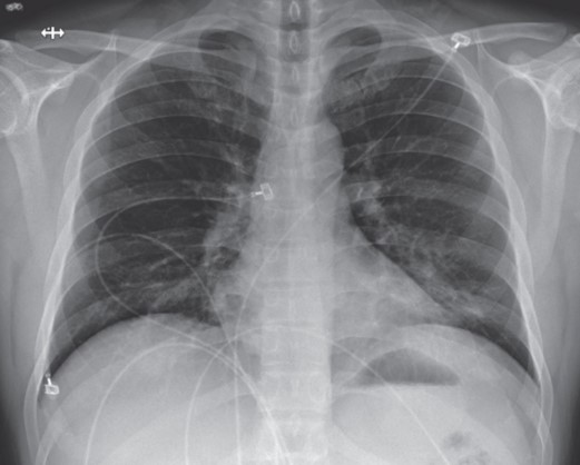 Trong vòng 2 tháng rưỡi, một người Việt 2 lần chẩn đoán bị viêm phổi